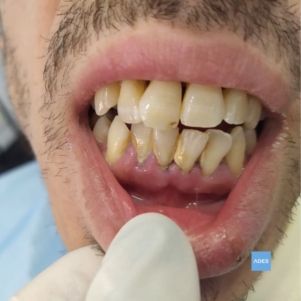 Tratamiento de enfermedad periodontal en Clínica Dental ADES, Badajoz - Encías saludables