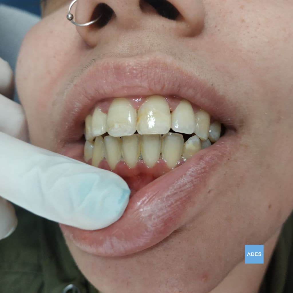 Tratamiento de gingivitis en Clínica Dental ADES, Badajoz - Encías inflamadas y sangrantes