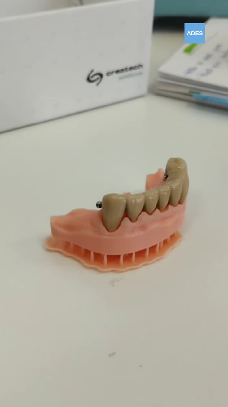 Prótesis dental realizada en 3D - Clínica Dental ADES, Badajoz - Precisión y personalización