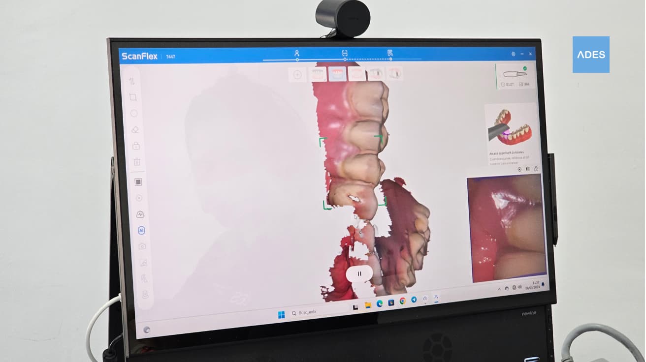 Escáner dental intraoral 3D en Clínica Dental ADES de Badajoz capturando imágenes digitales de alta precisión para planificación de tratamientos