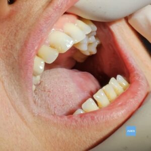 Diente con caries previo a obturación estética en Clínica Dental ADES de Badajoz, mostrando zona dañada a tratar con composite del color del diente