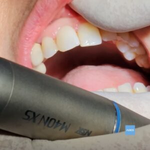Resultado final de obturación dental estética en Clínica Dental ADES de Badajoz, mostrando empaste de composite perfectamente integrado con el color natural del diente