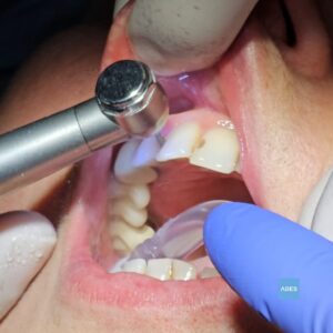 Odontólogo realizando obturación dental estética con composite en Clínica Dental ADES de Badajoz, aplicando material del color del diente con precisión milimétrica