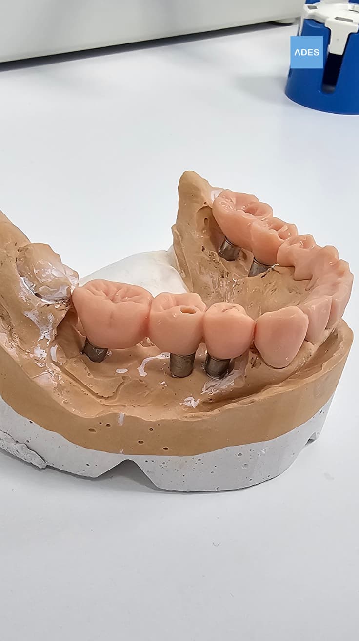 Prototipo de prótesis dental impreso en 3D en Clínica Dental ADES de Badajoz, mostrando diseño personalizado antes de fabricación definitiva
