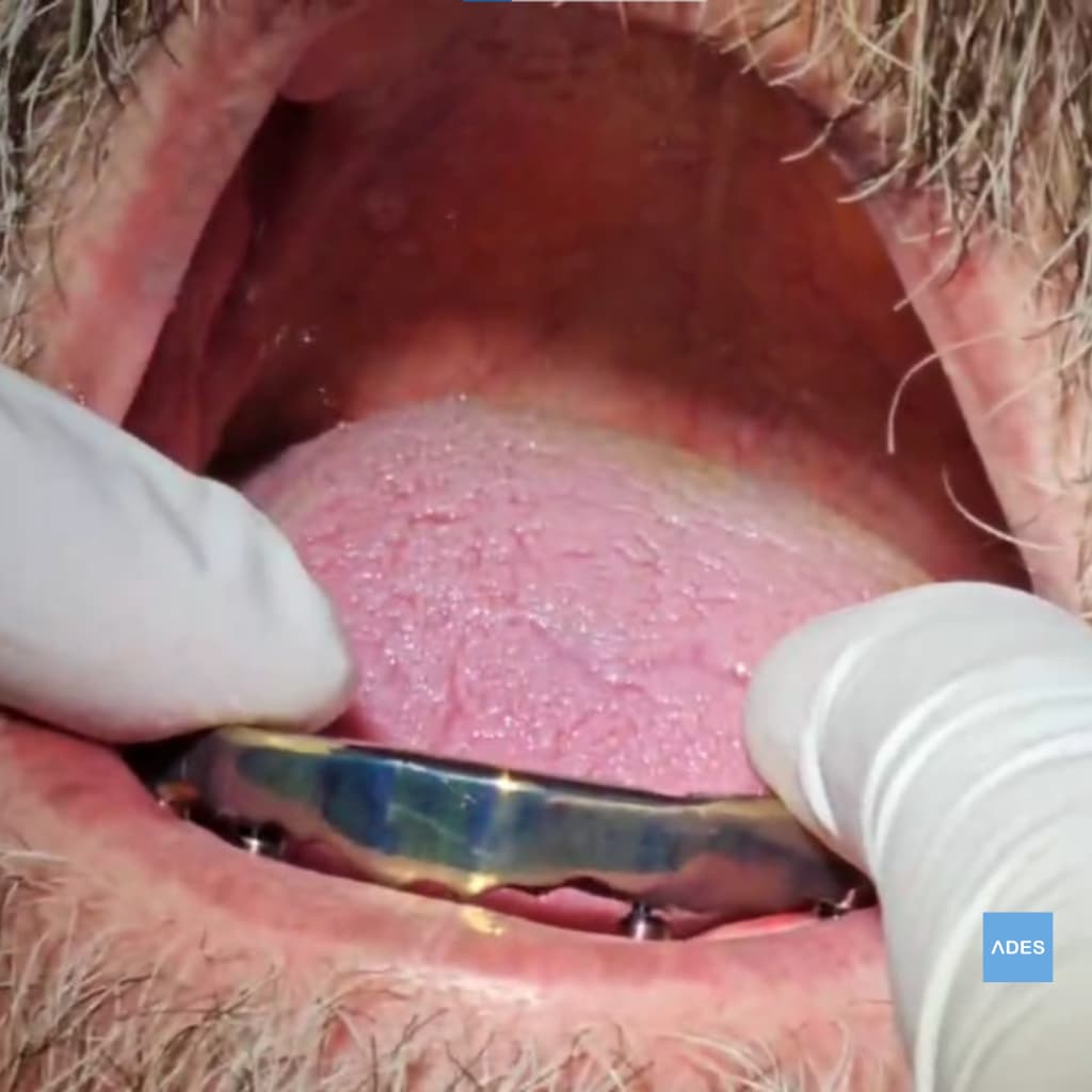 Barra Ackerman en Arcada Inferior - Clínica Dental ADES, Badajoz Barra Ackerman en arcada inferior - Clínica Dental ADES, Badajoz - Soporte y comodidad