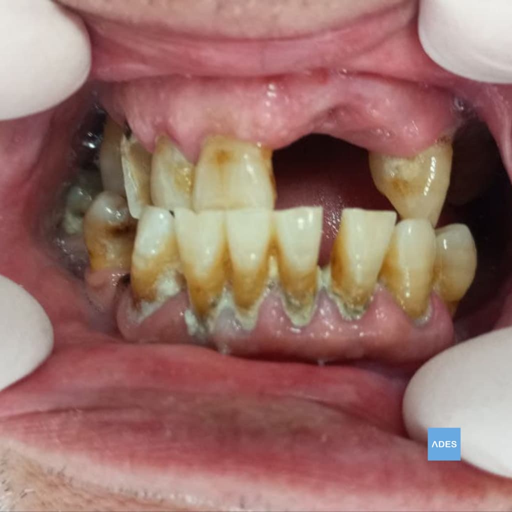 Tratamiento de enfermedad periodontal en Clínica Dental ADES, Badajoz - Encías saludables