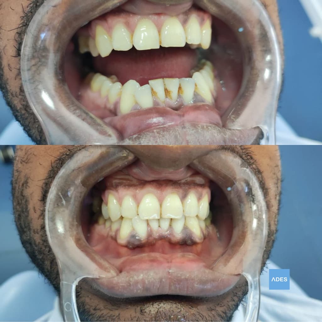 Limpieza dental profesional en Clínica Dental ADES, Badajoz - Eliminación de placa y sarro