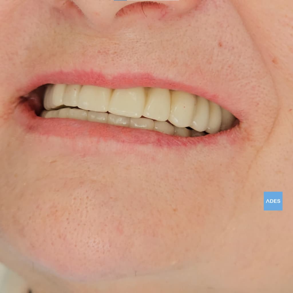Después del Tratamiento "All on 4" - Clínica Dental ADES, Badajoz Boca de paciente después del tratamiento "All on 4" - Clínica Dental ADES, Badajoz - Sonrisa funcional y estética