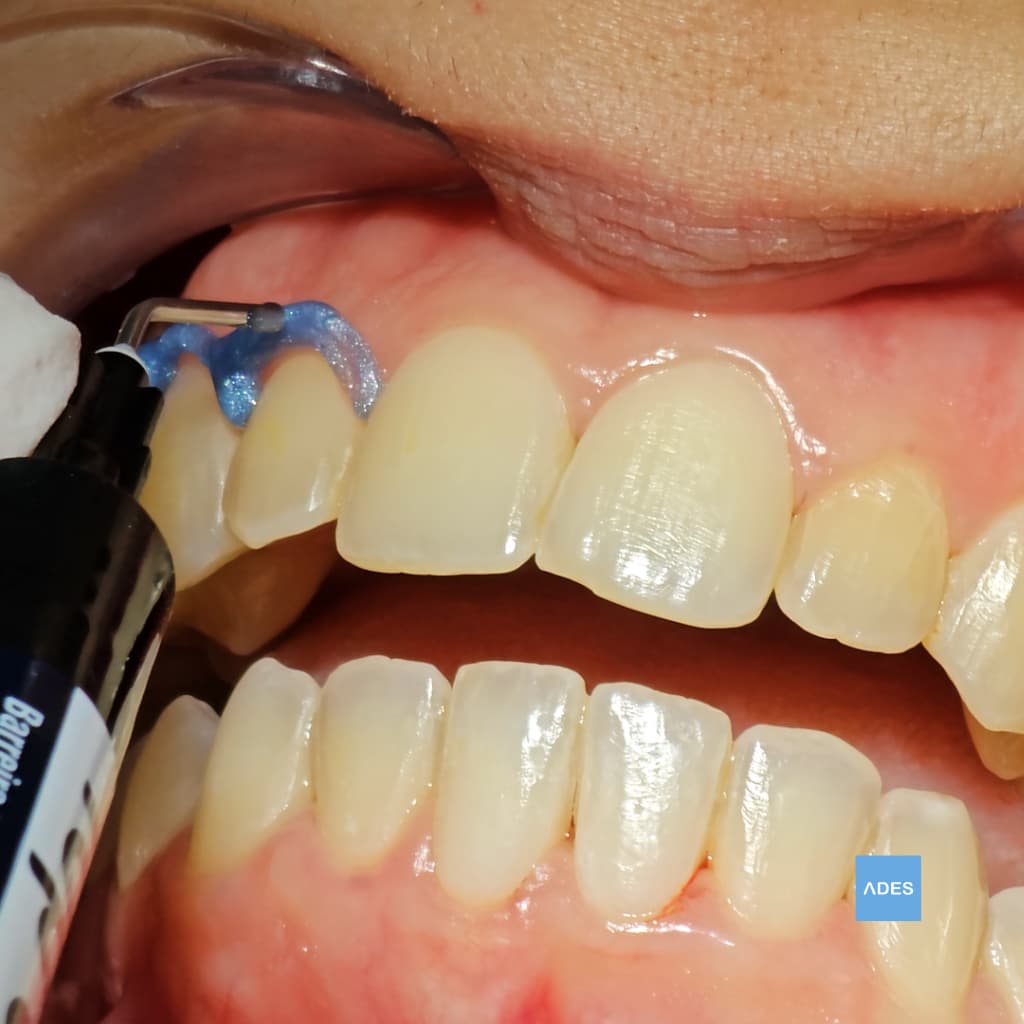 Inicio de Blanqueamiento Dental - Clínica Dental ADES, Badajoz Inicio del procedimiento de blanqueamiento dental en Clínica Dental ADES, Badajoz - Tratamiento seguro y profesional