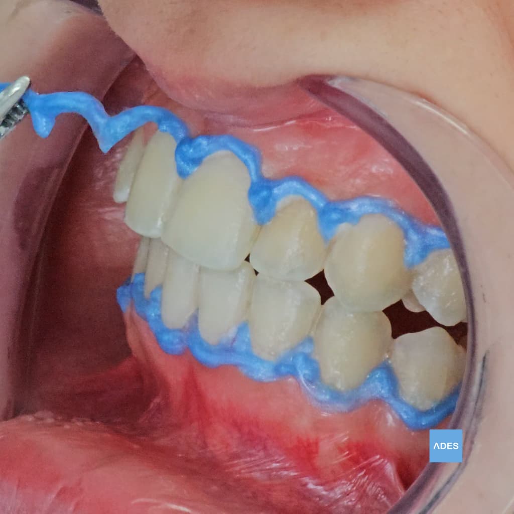 Blanqueamiento Dental - Clínica Dental ADES, Badajoz Blanqueamiento dental en Clínica Dental ADES, Badajoz - Sonrisa más blanca y radiante
