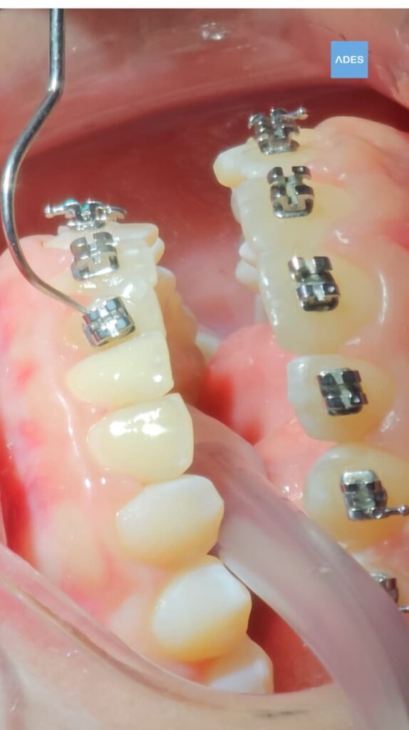 Brackets Metálicos - Clínica Dental ADES, Badajoz Brackets metálicos en Clínica Dental ADES, Badajoz - Corrección dental efectiva y confiable