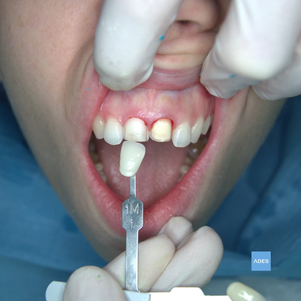 Carillas Dentales - Clínica Dental ADES, Badajoz Carillas dentales antes de su colocación en Clínica Dental ADES, Badajoz - Solución estética personalizada