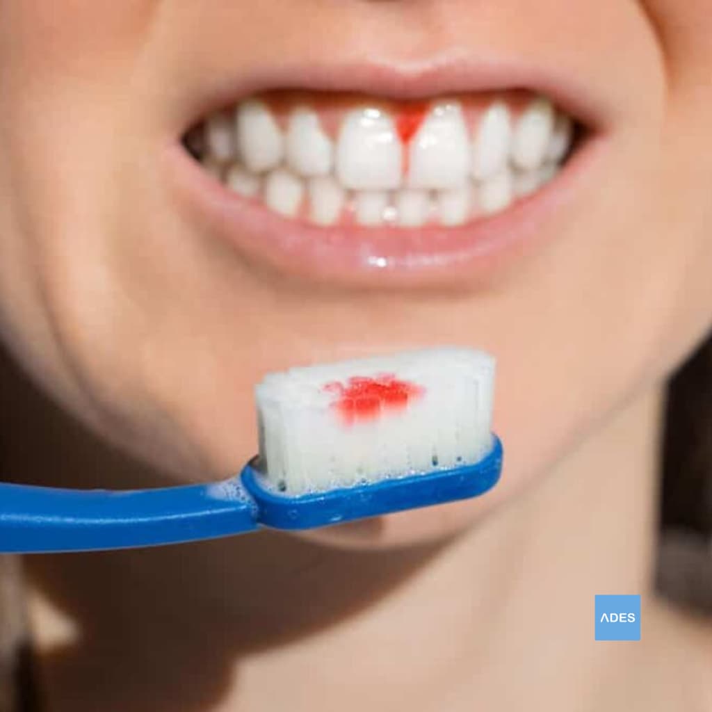 Encías que sangran al cepillarse o usar hilo dental - Clínica Dental ADES, Badajoz