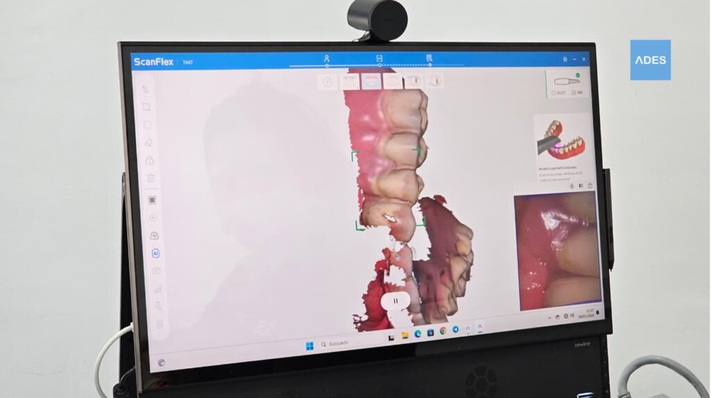Escáner Intraoral 3D - Clínica Dental ADES, Badajoz Escáner intraoral 3D en Clínica Dental ADES, Badajoz - Tecnología avanzada para diagnósticos precisos