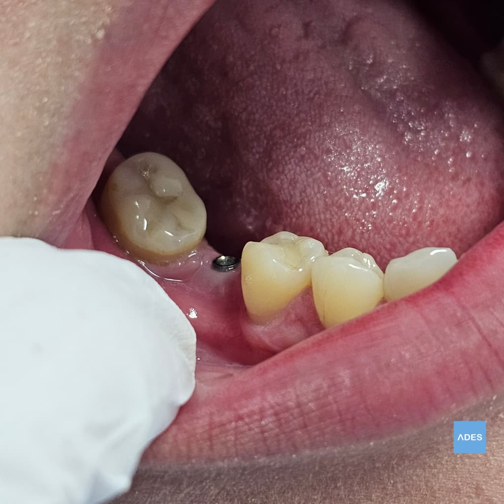 Implante Unitario - Clínica Dental ADES, Badajoz Implante unitario antes de la colocación de la corona - Clínica Dental ADES, Badajoz
