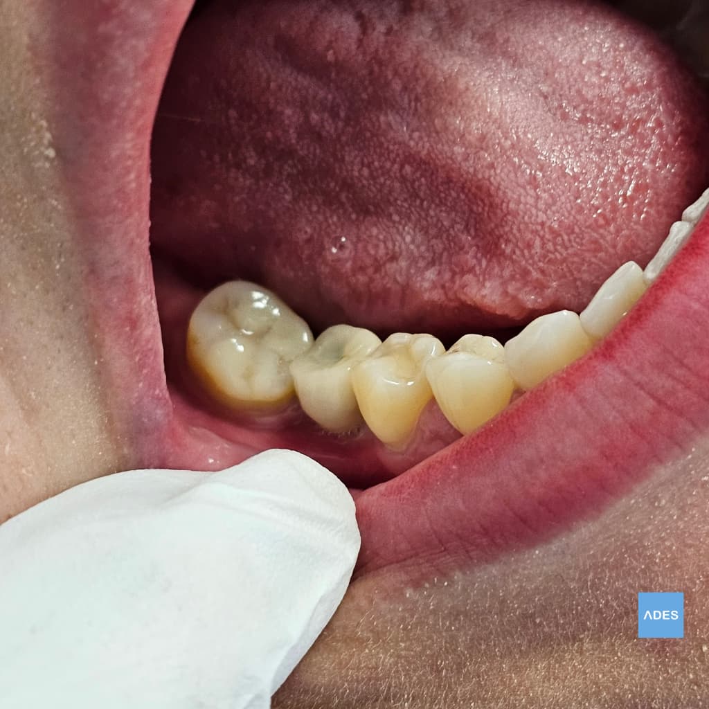 Implante Unitario con Corona - Clínica Dental ADES, Badajoz Implante unitario con corona colocada - Clínica Dental ADES, Badajoz - Sonrisa funcional y estética