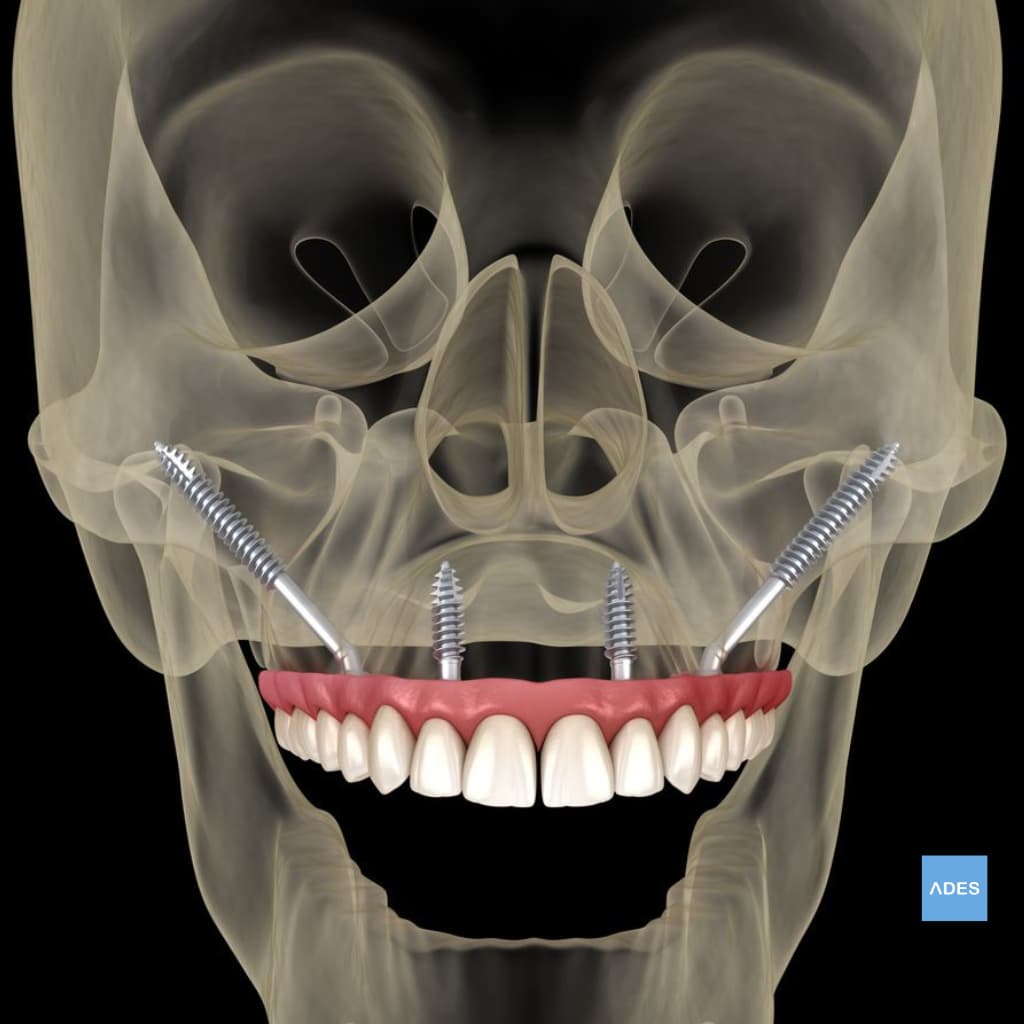 Implantes Cigomáticos - Solución sin Injertos Óseos - Clínica Dental ADES, Badajoz Tratamiento con implantes cigomáticos en Clínica Dental ADES, Badajoz - Restauración dental sin injertos óseos