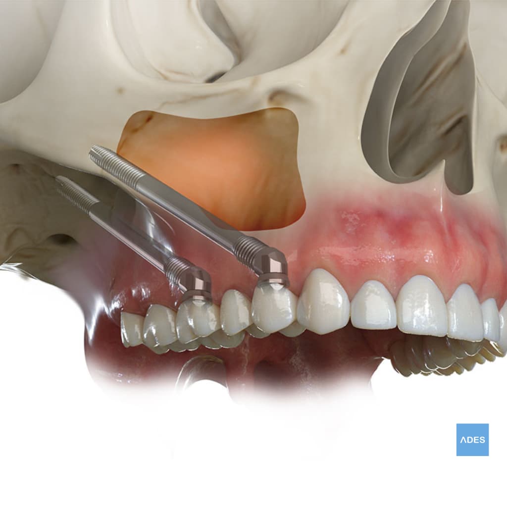 Implantes Cigomáticos - Clínica Dental ADES, Badajoz Implantes cigomáticos en Clínica Dental ADES, Badajoz - Solución avanzada para sonrisas completas