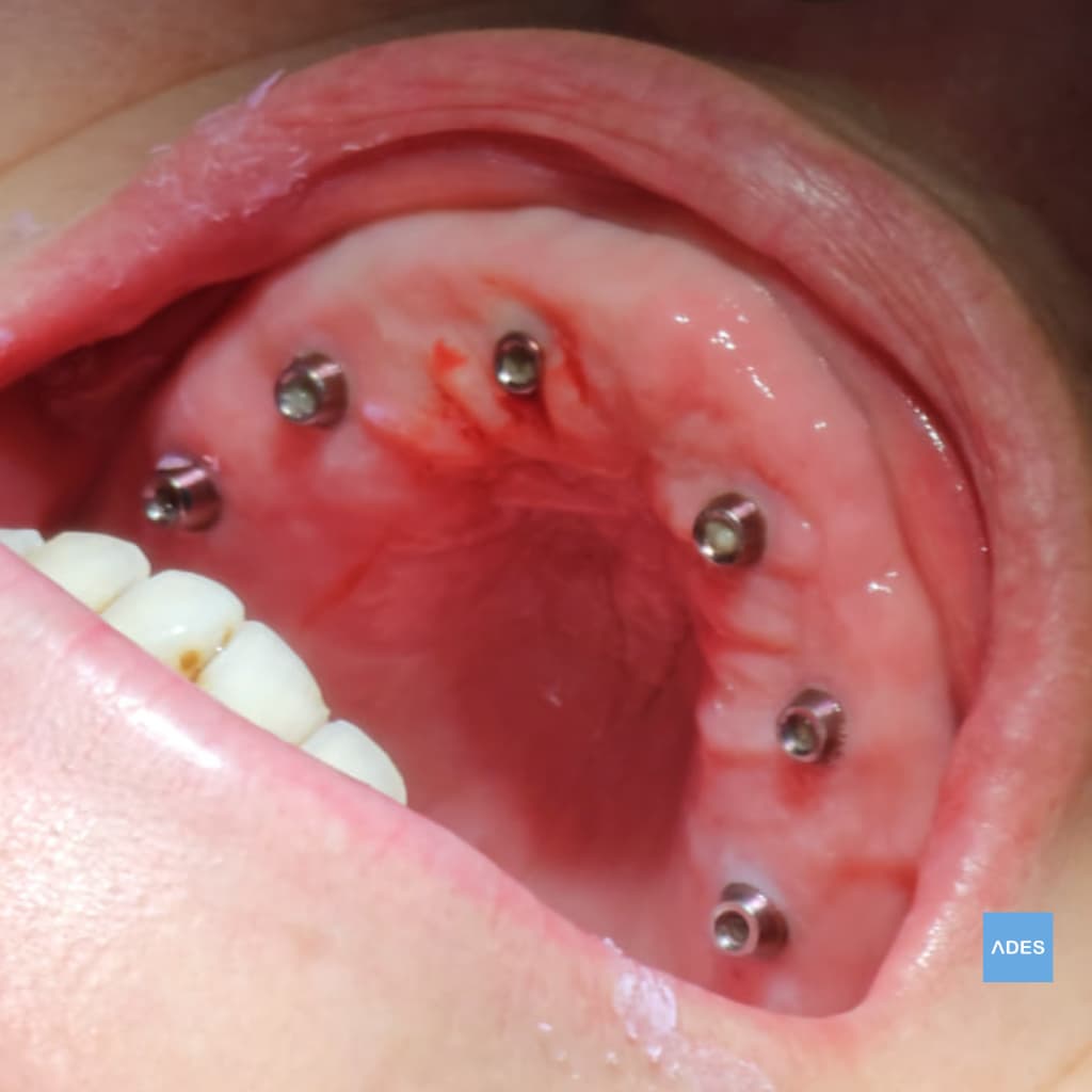 6 Implantes Colocados - Clínica Dental ADES, Badajoz 6 implantes colocados para prótesis híbrida - Clínica Dental ADES, Badajoz - Base sólida para restauración