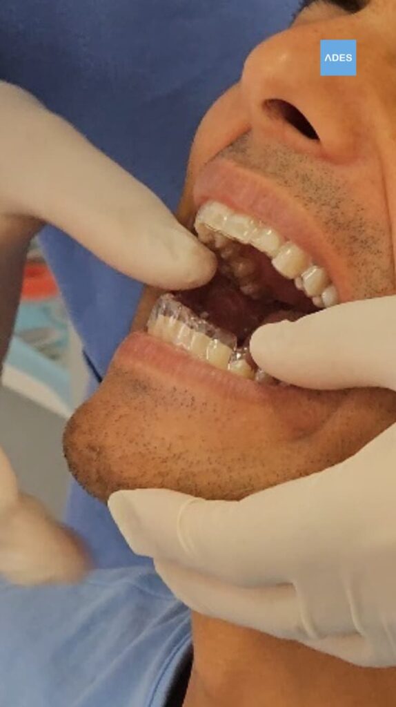Ortodoncia Invisible - Clínica Dental ADES, Badajoz Ortodoncia invisible en Clínica Dental ADES, Badajoz - Corrección dental discreta y efectiva