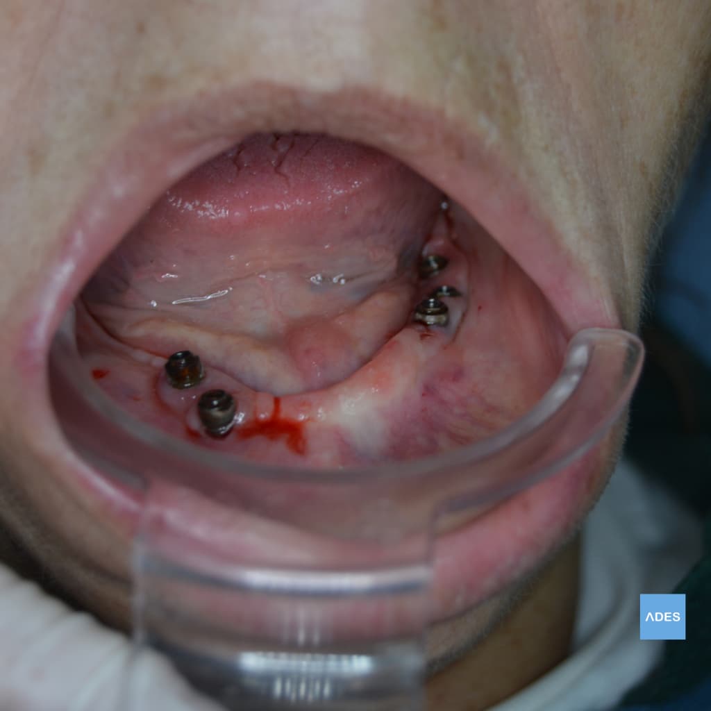 Prótesis sobre Implantes Locator - Clínica Dental ADES, Badajoz Prótesis sobre implantes Locator en Clínica Dental ADES, Badajoz - Sonrisa funcional y estética