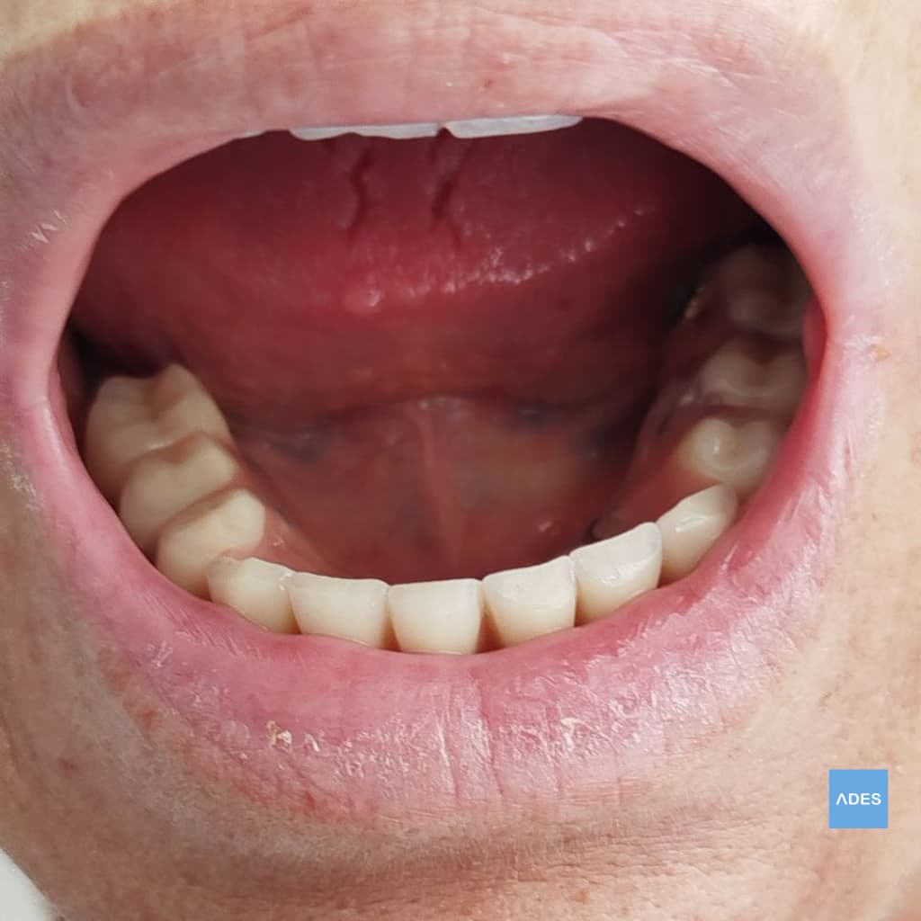Implantes Locator - Clínica Dental ADES, Badajoz Implantes Locator en Clínica Dental ADES, Badajoz - Estabilidad y retención avanzada