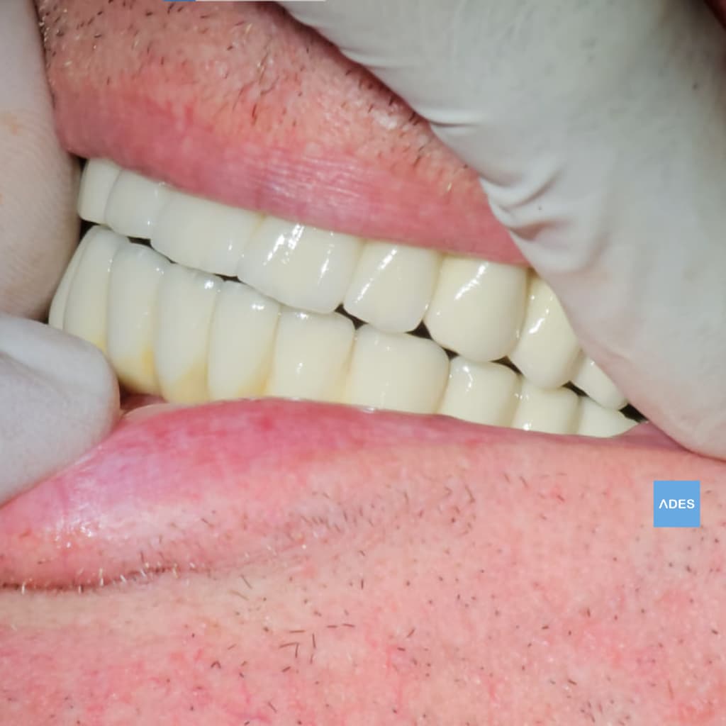 Prótesis de Zirconio sobre Implantes - Clínica Dental ADES, Badajoz Prótesis de zirconio sobre implantes colocada - Clínica Dental ADES, Badajoz - Sonrisa natural y funcional