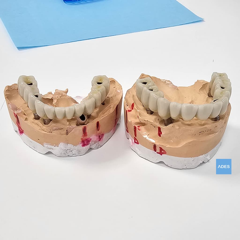 Prótesis de Zirconio sobre Implantes - Clínica Dental ADES, Badajoz Prótesis de zirconio sobre implantes sin colocar - Clínica Dental ADES, Badajoz - Material de alta calidad