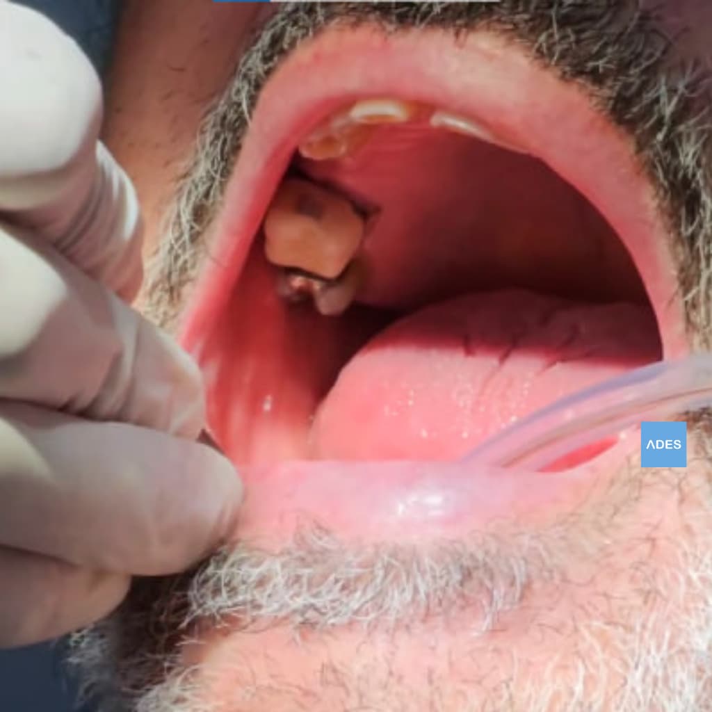 Puente sobre Implantes - Clínica Dental ADES, Badajoz Puente sobre implantes antes de la colocación de coronas - Clínica Dental ADES, Badajoz