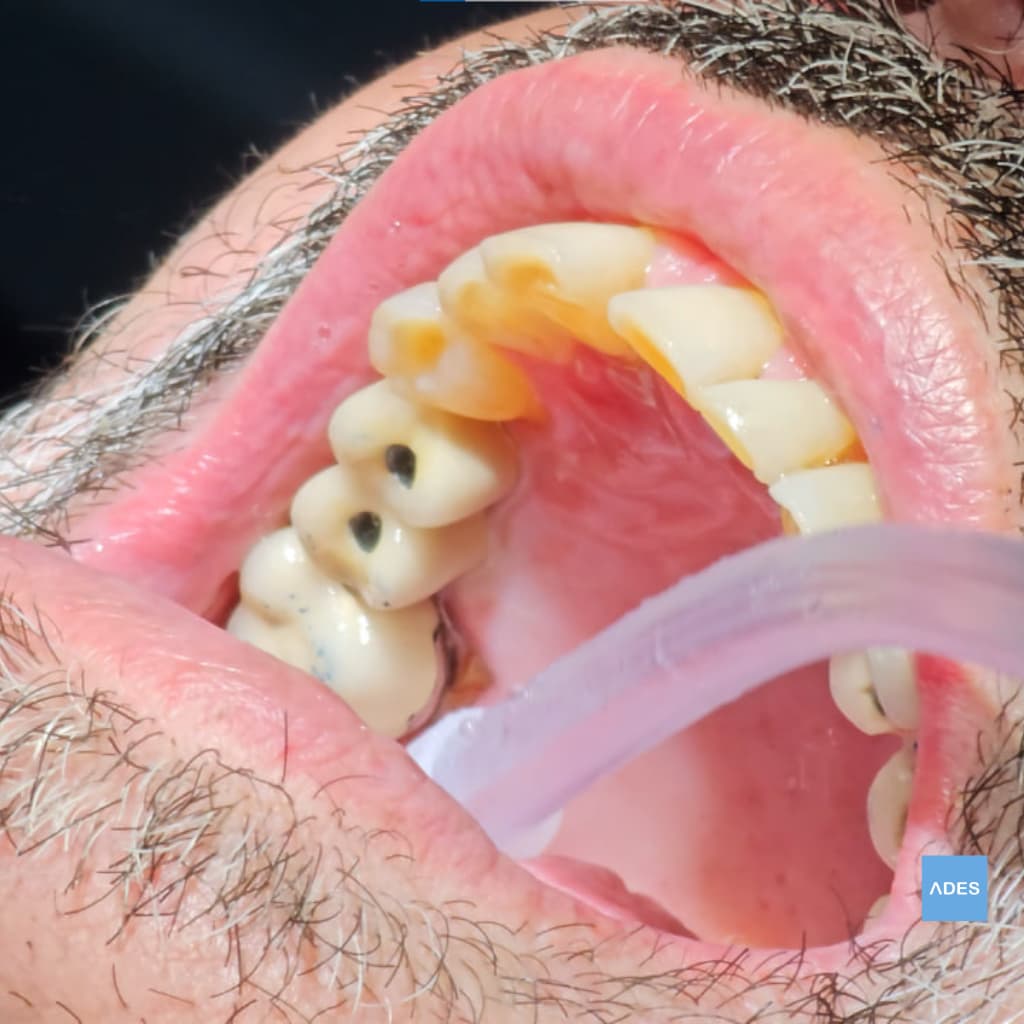 Puente sobre Implantes con Coronas - Clínica Dental ADES, Badajoz Puente sobre implantes con coronas colocadas - Clínica Dental ADES, Badajoz - Sonrisa funcional y estética