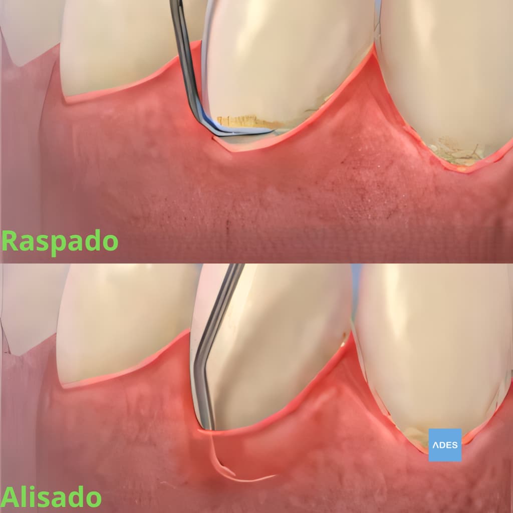 Raspado y alisado radicular en Clínica Dental ADES, Badajoz - Tratamiento periodontal