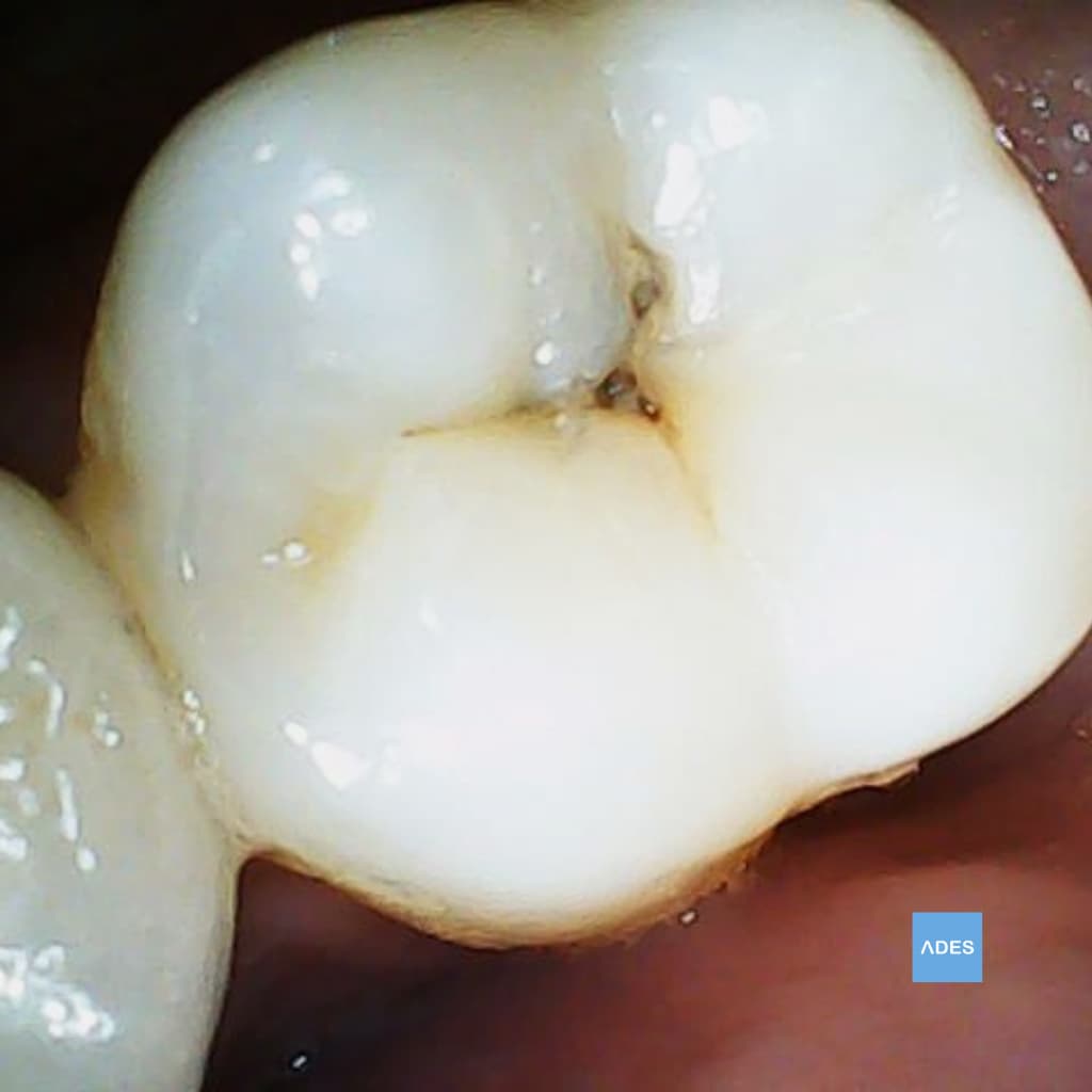 Caries Dental Avanzada en Badajoz | Diagnóstico y Tratamiento | Clínica ADES Caries dental avanzada en paciente de Clínica Dental ADES (Badajoz), mostrando deterioro del esmalte y dentina que requiere tratamiento urgente
