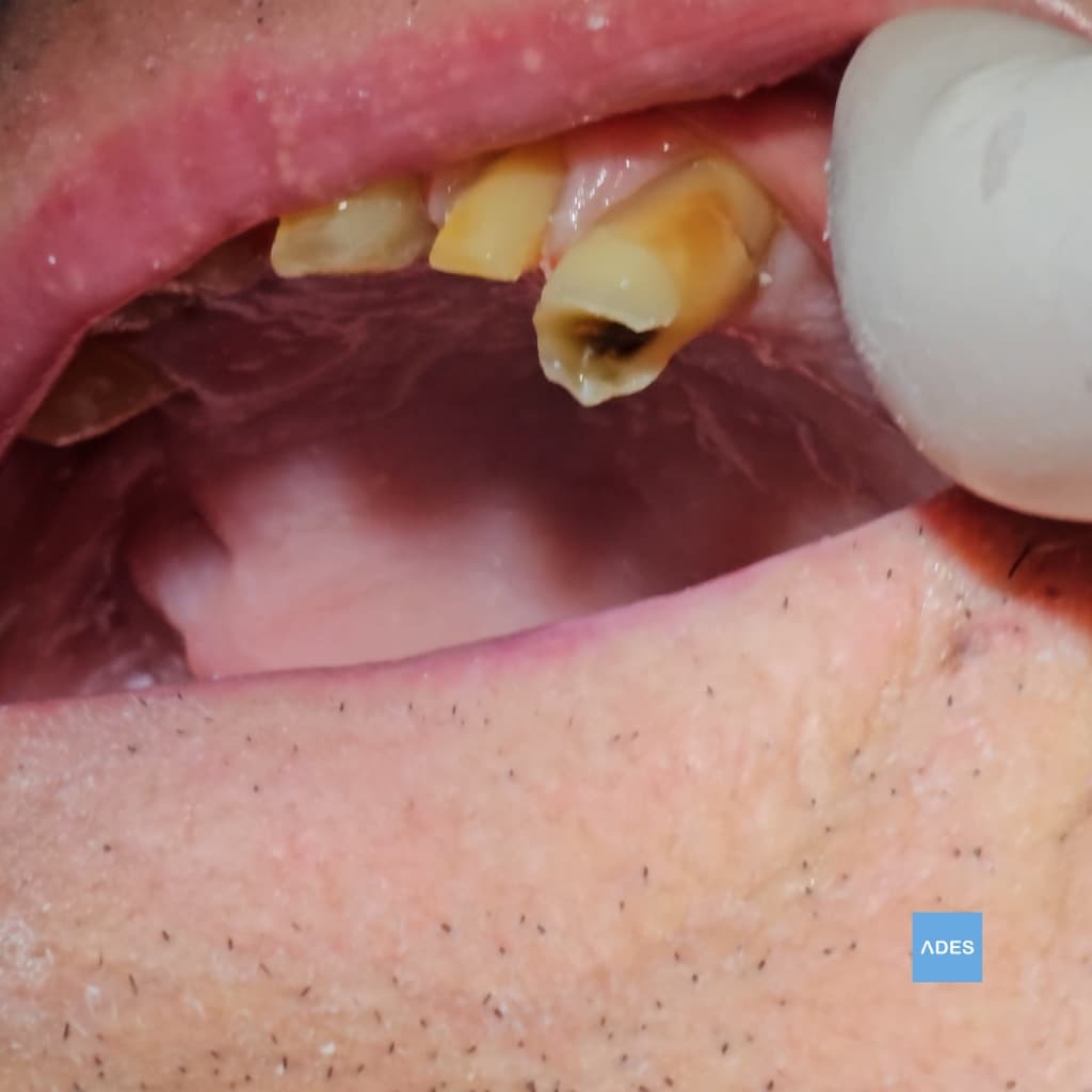 Caries dental antes de tratamiento - Obturación conservadora en Badajoz | Clínica ADES Diente con caries antes de obturación dental en Clínica Dental ADES de Badajoz, mostrando daño a tratar con técnicas conservadoras
