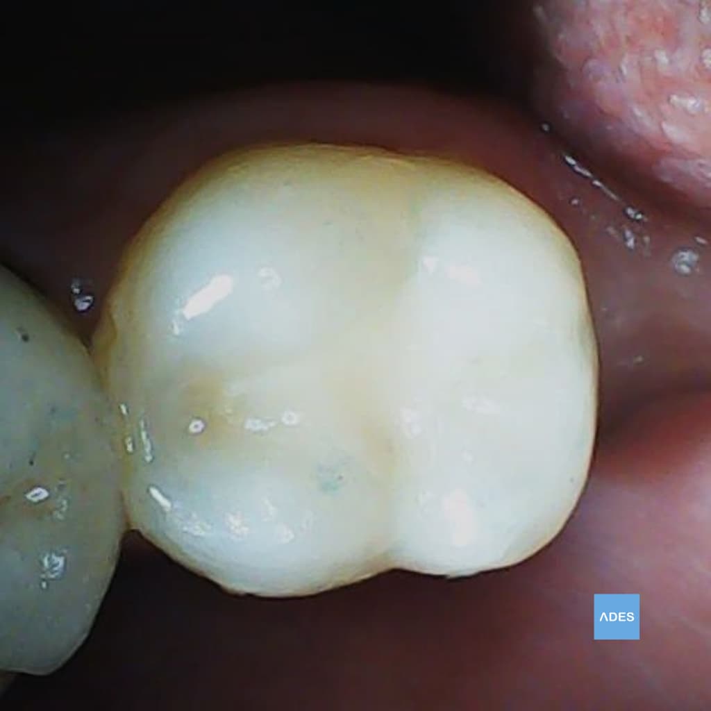 Caries Dental Reparada en Badajoz | Resultado Obturación Estética | Clínica ADES Diente con caries reparado mediante obturación estética en Clínica Dental ADES de Badajoz, mostrando restauración perfectamente integrada con el esmalte natural