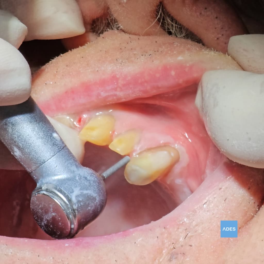 Resultado de Obturación Dental en Badajoz | Empaste Estético | Clínica ADES Resultado final de obturación dental en Clínica Dental ADES de Badajoz, mostrando restauración perfectamente integrada con el diente natural