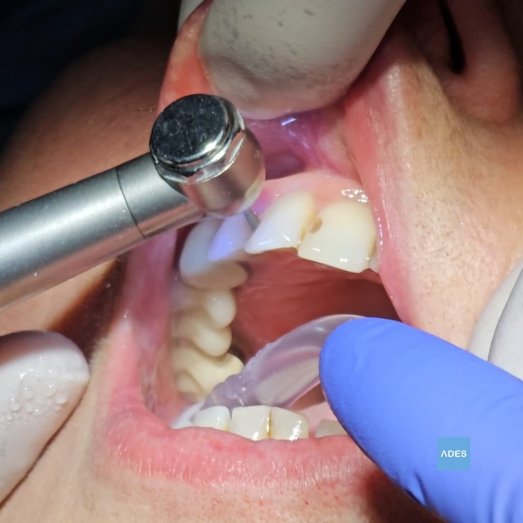 Obturación con composite en odontología conservadora en Clínica Dental ADES, Badajoz
