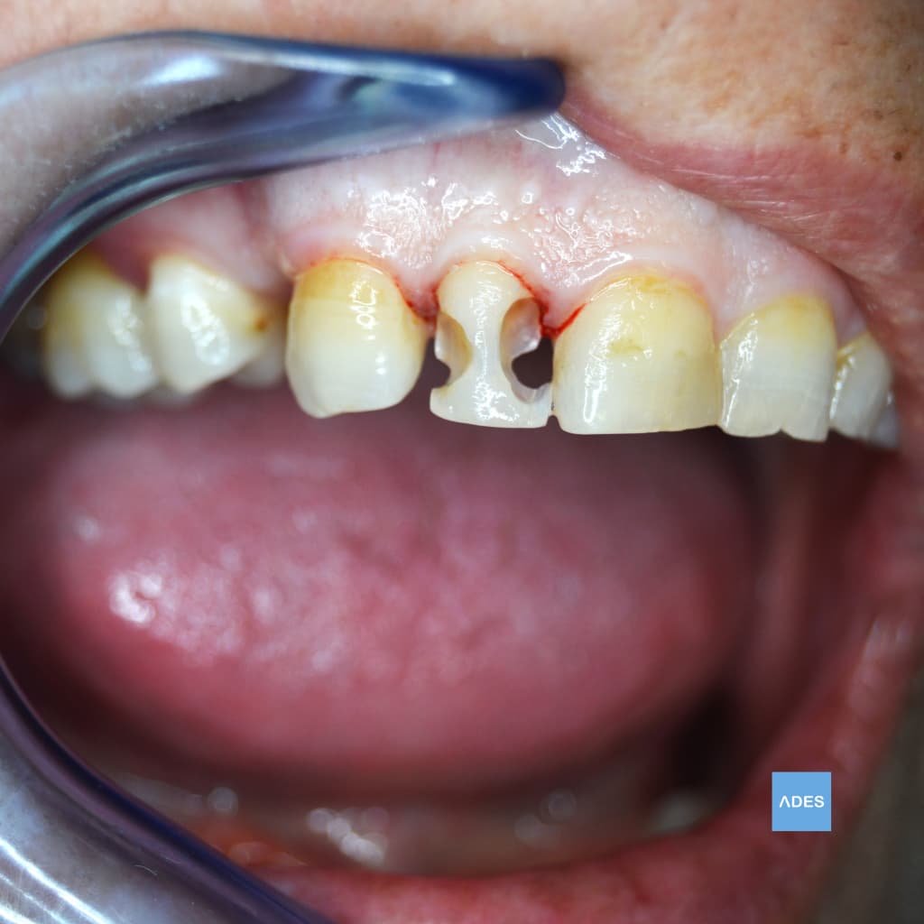 Reconstrucción Dental en Badajoz - Estado Inicial | Clínica Dental ADES Diente gravemente dañado antes de reconstrucción dental en Clínica Dental ADES de Badajoz, mostrando estructura deteriorada a restaurar
