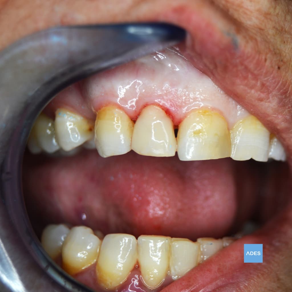 Caso finalizado en nuestra clínica: diente severamente dañado recuperado mediante reconstrucción estratificada con composite de última generación, devolviendo función y estética natural. Reconstrucción dental finalizada con composite en Clínica Dental ADES de Badajoz, mostrando restauración estética perfectamente integrada en diente gravemente dañado