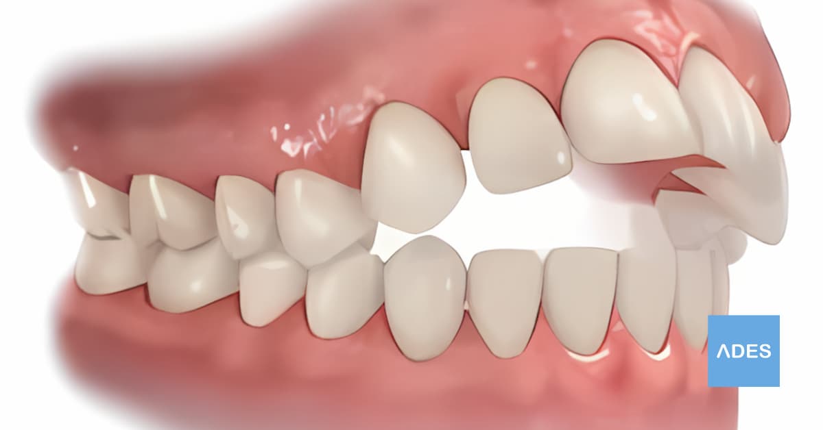 Modelo 3D de mordida abierta anterior en pantalla digital, Clínica Dental ADES Badajoz